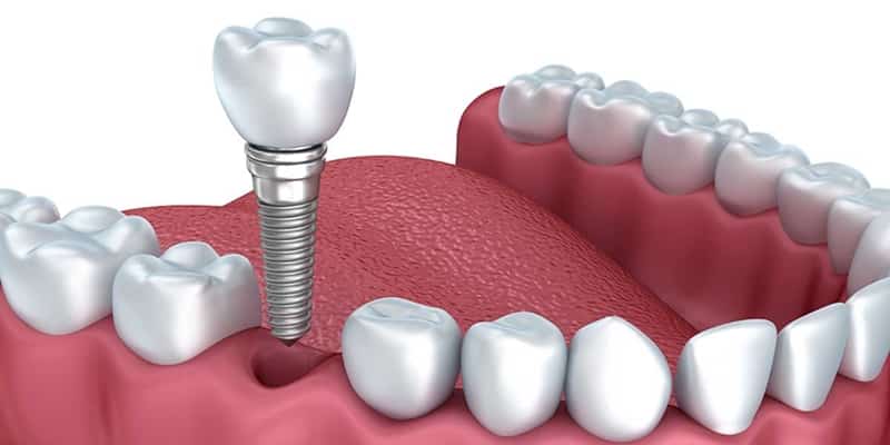 Implantes dentales y prótesis ¿cuál es la mejor opción para ti