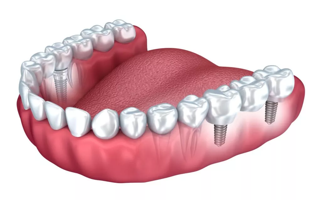 ¿Son los implantes dentales adecuados para ti? factores a considerar