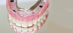 ¿Son los implantes dentales adecuados para ti? factores a considerar