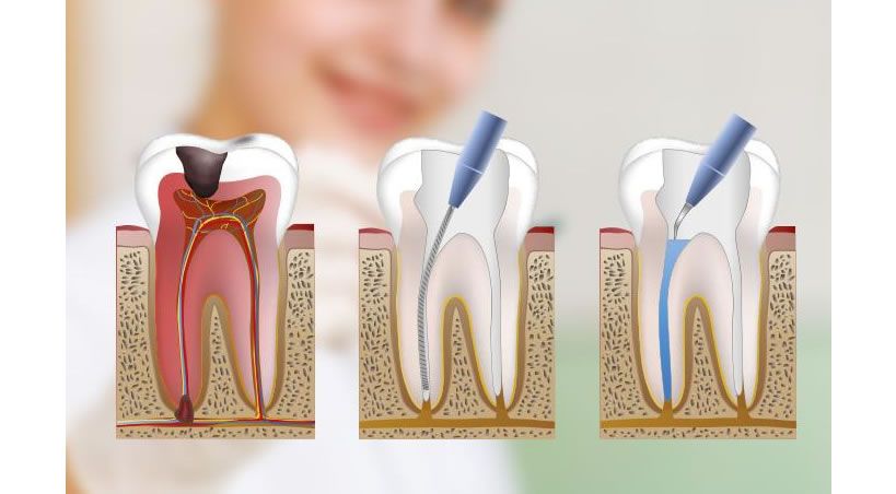 Endodoncia: mitos y realidades sobre el tratamiento de conducto